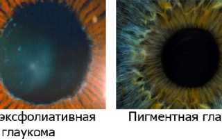 Методы лечения остроугольной глаукомы: современные подходы и рекомендации