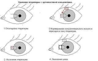 Удаление птеригиума лазером за 3 минуты: быстро и эффективно