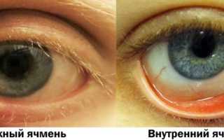 5 методов лечения холодного ячменя в домашних условиях