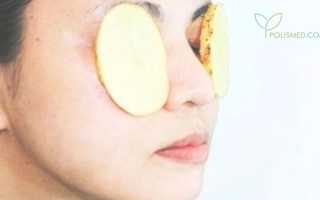 Как быстро убрать синяк под глазом и на теле в домашних условиях? Полезные советы