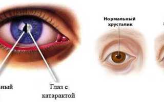 Первые признаки и причины катаракты: что нужно знать