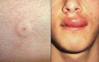 Укус пчелы, осы, что делать? Первая помощь при укусе пчелы, осы, шершня и советы по уходу.