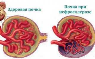 Нефросклероз почек лечение