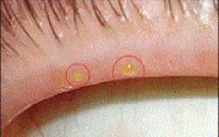 Халязион верхнего и нижнего века: причины, симптомы, диагностика и операции по удалению