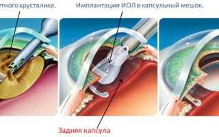 6 преимуществ лазерного лечения катаракты для здоровья глаз