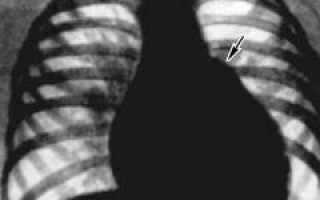 Дефект межпредсердной перегородки: причины и лечение