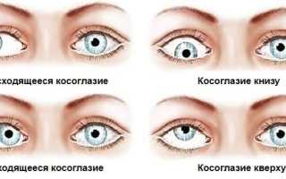 Упражнения от косоглазия для взрослых и детей: полезные советы
