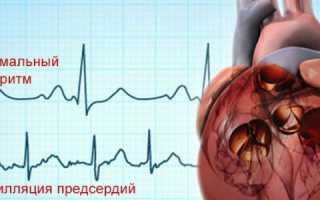 Антиаритмические препараты – виды лекарств и список самых эффективных для лечения