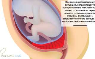 Предлежание плаценты. Причины, признаки, классификация, последствия, диагностика и лечение патологии. Как подготовиться к родам? Как лучше рожать? Что нельзя делать при данном состоянии? Полезные советы для будущих мам