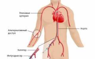 Коронарография. Что такое коронарография, показания, какие болезни выявляет и как проводится
