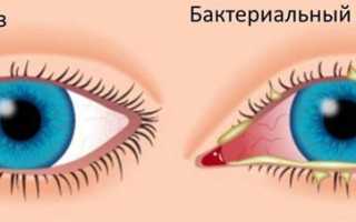 Методы лечения бактериального конъюнктивита: эффективные подходы и рекомендации