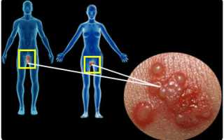 Генитальный герпес — причины, симптомы, современная диагностика, эффективное лечение и профилактика болезни для здоровья.