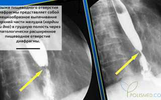 Грыжа пищеводного отверстия диафрагмы (хиатальная грыжа). Причины, симптомы, диагностика и лечение патологии для здоровья