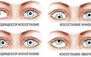 6 методов коррекции сходящегося косоглазия у детей: советы и рекомендации