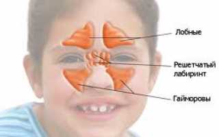 Гайморит — причины, симптомы, современная диагностика и эффективное лечение болезни у взрослых