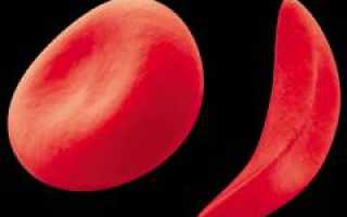 В12 дефицитная анемия – причины, симптомы, диагностика и лечение заболевания