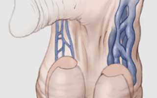 Варикоцеле – причины, симптомы, диагностика и лечение: показания к операции, подготовка, виды операции, после операции, возможные осложнения после операции. Советы по восстановлению.