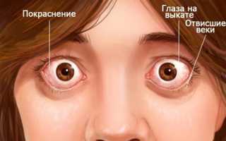Лечение разных видов экзофтальма (пучеглазия) у пациентов