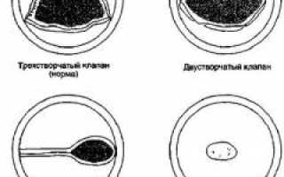 Аортальный стеноз: причины и последствия