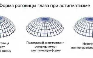 Особенности лечения врожденного астигматизма у детей