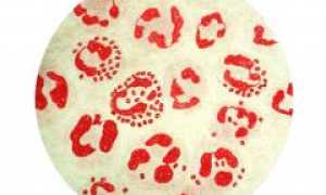 Баланопостит у детей и взрослых — причины, симптомы, лечение. Мази эффективные при баланопостите и рекомендации