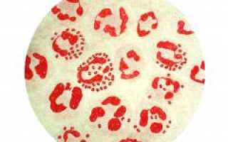 Баланопостит у детей и взрослых — причины, симптомы, лечение. Мази эффективные при баланопостите и рекомендации