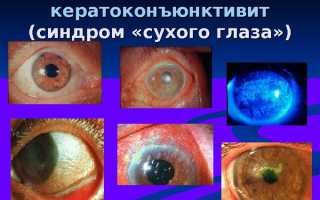 Как лечить разные виды кератоконъюнктивита у взрослых и детей