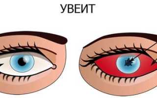 Расплывчатая симптоматика увеита: причины и последствия