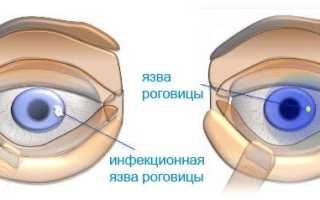 Язвенные поражения роговицы глаза и возможная потеря зрения: причины и лечение