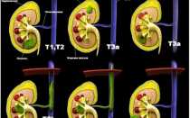 Опухоли почек классификация