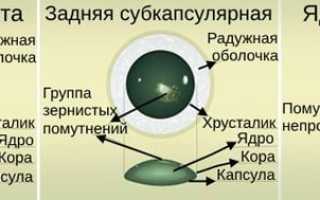 Секреты развития ядерной катаракты: важные аспекты и рекомендации
