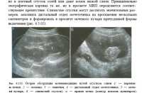 Микрокальцинаты в почках что это такое