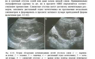 Микрокальцинаты в почках что это такое