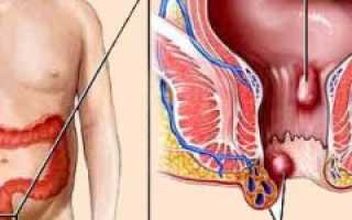Геморрой — причины и признаки, виды — наружный и внутренний геморрой, стадии, профилактика. Лечение: диета, свечи, мази – что лучше для здоровья?
