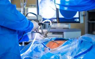 Лапароскопия кисты почки