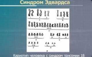 Синдром Эдвардса (трисомия 18). Причины, симптомы, признаки, диагностика и лечение патологии у детей