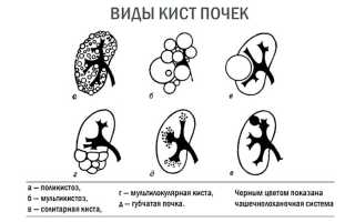 Аномалии почек классификация