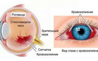 Опасность субконъюнктивального кровоизлияния для здоровья глаз