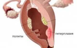 Гиперплазия эндометрия: виды, причины, симптомы, диагностика и лечение различных форм заболевания