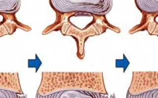Ишиас — симптомы, причины, диагностика и лечение. Как лечить ишиас: гимнастика, упражнения, массаж для улучшения состояния.
