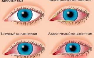 Какие антибиотики назначают при хламидийной конъюнктивите для эффективного лечения