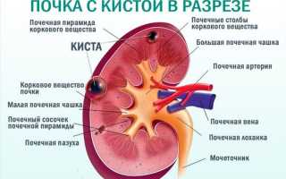 Интрапаренхиматозная киста почки