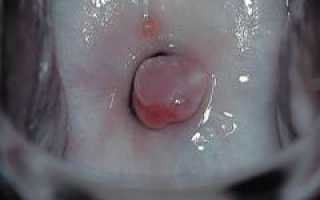 Полипы шейки матки. Причины, симптомы и признаки, лечение и профилактика патологии для женщин