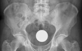 Вульвовагинит — причины, симптомы, признаки, диагностика и лечение. Острый, хронический, атрофический, специфические виды вульвовагинита. Бактериальный, кандидозный, трихомонадный уретрит и их особенности.