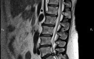 Болит спина. Диагностика и лечение болей в позвоночнике, в области лопаток, под ребрами, болей в спине справа или слева — советы и рекомендации
