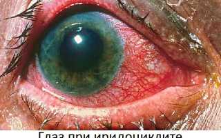 Опасность иридоциклита и методы лечения воспаления глаза: важные аспекты здоровья