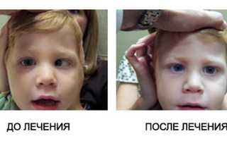 Формы амблиопии и способы их лечения: важные аспекты и рекомендации