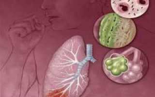 Саркоидоз. Причины, симптомы, признаки, диагностика и лечение патологии у пациентов