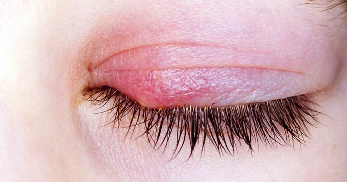 аллергический блефарит