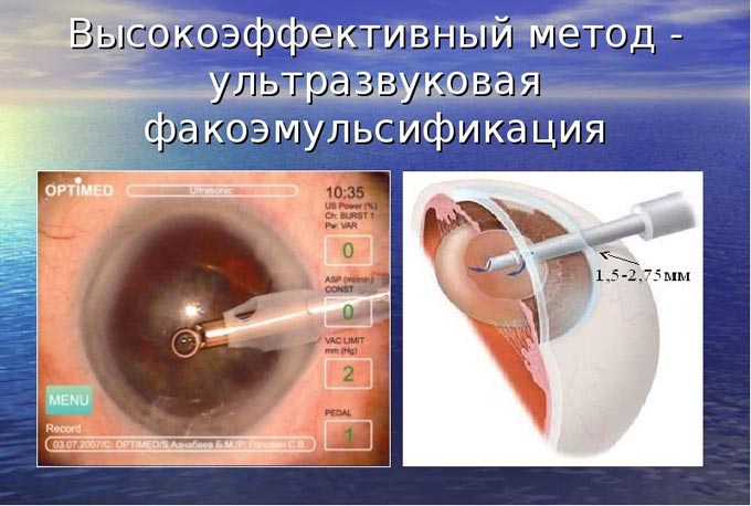 факоэмульсификация